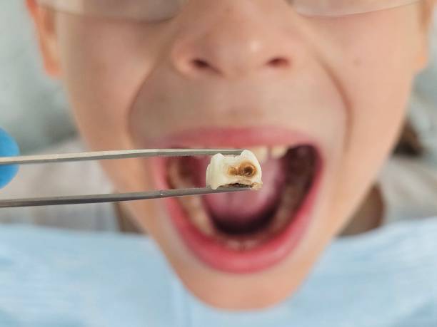 Best Urgent Care for Lost Fillings or Crowns in Houma, LA
